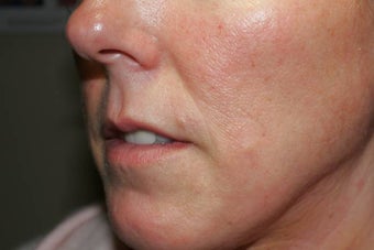 Fillers - Cosmoderm
