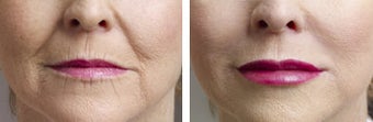  Collagen Injections