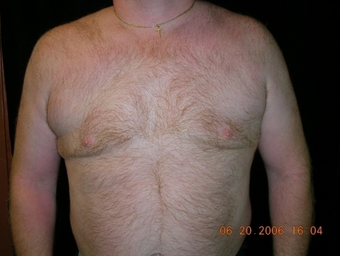 Cool Lipo