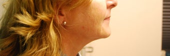 Laser Lipo