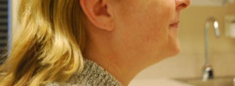 Laser Lipo
