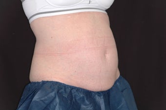 Zetiq Precedure for Abdomen