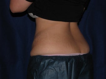 CoolSculpting