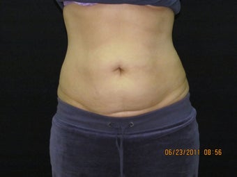 CoolSculpting