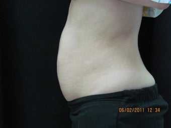 CoolSculpting