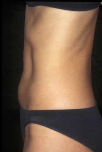 CoolSculpting treatment of unwanted tummy fat
