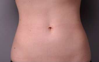 Coolsculpting Non-Invasive Fat Reduction