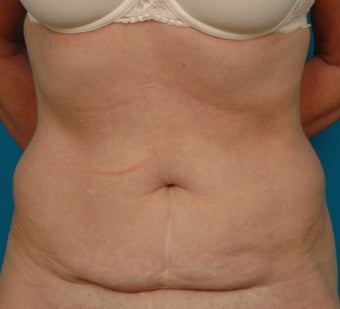 Coolsculpting