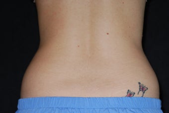 CoolSculpting/flanks