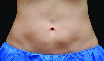 Body contouring