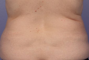 CoolSculpting to Bra Rolls/Back Fat