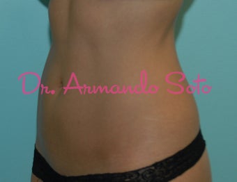 Coolsculpting by Zeltiq