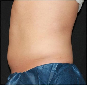 CoolSculpting