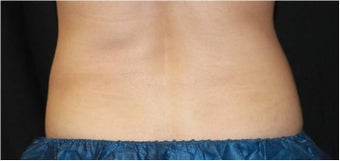 CoolSculpting