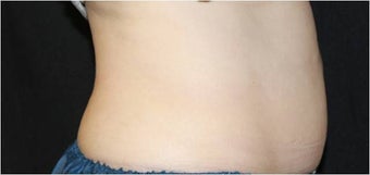 CoolSculpting