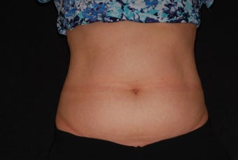 CoolSculpting