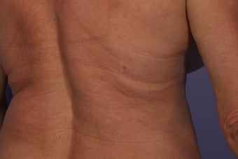 CoolSculpting to Bra/Back Rolls