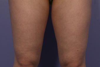 CoolSculpting Inner Thighs
