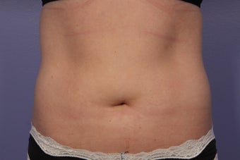 CoolSculpting to Abdomen