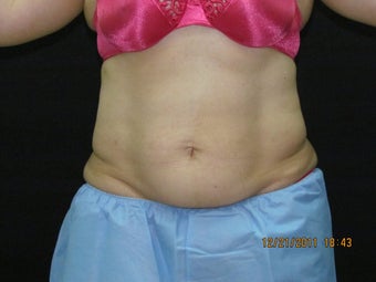 CoolSculpting
