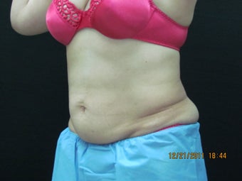 CoolSculpting