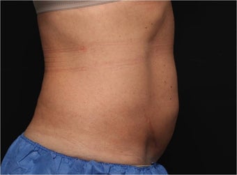 NonInvasive Fat Removal with CoolSculpting - Invented by Dr. Dieter Manstein