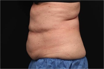 NonInvasive Fat Removal with CoolSculpting - Invented by Dr. Dieter Manstein