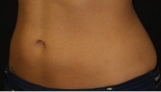 Coolsculpting-lower abdomen