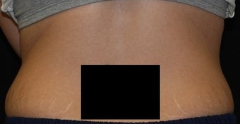Coolsculpting - Flanks