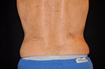 CoolSculpting