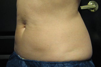 Zeltiq CoolSculpting