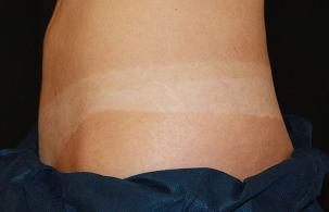 CoolSculpting - FreezeThisFat