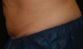 CoolSculpting - FreezeThisFat