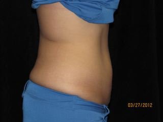 Coolsculpting