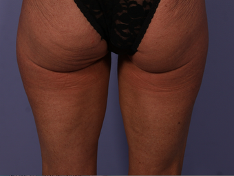 CoolSculpting to Banana Roll, Upper Posterior Thighs