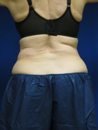 Coosculpting
