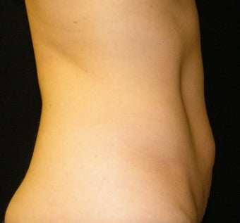 CoolSculpting