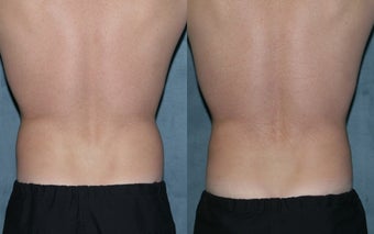 Zeltiq for fat reduction on "love handles"