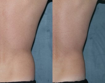 Zeltiq for fat reduction on "love handles"