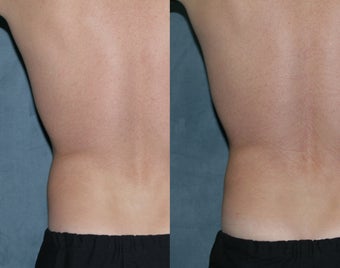 Zeltiq for fat reduction on "love handles"
