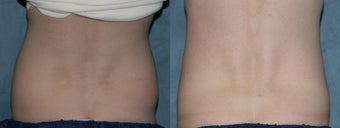 Zeltiq for fat reduction on "muffin top" / flanks