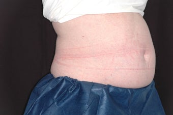 Zetiq Precedure for Abdomen