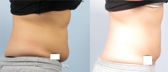 Coolsculpting - Zeltiq