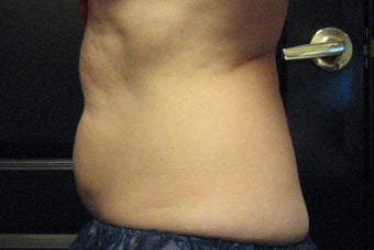 Zeltiq CoolSculpting