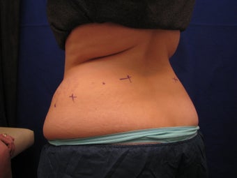 CoolSculpting
