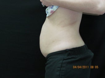 CoolSculpting