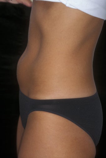 CoolSculpting treatment of unwanted tummy fat