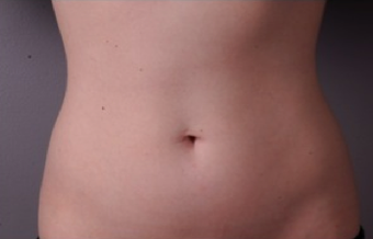 Coolsculpting Non-Invasive Fat Reduction