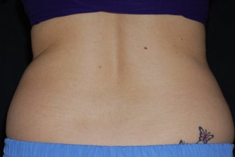 CoolSculpting/flanks