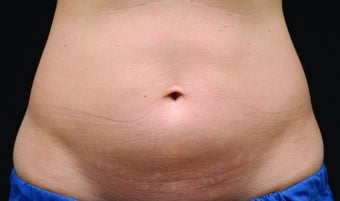 Body contouring